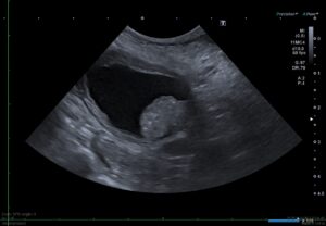 膀胱三角部にできた腫瘍